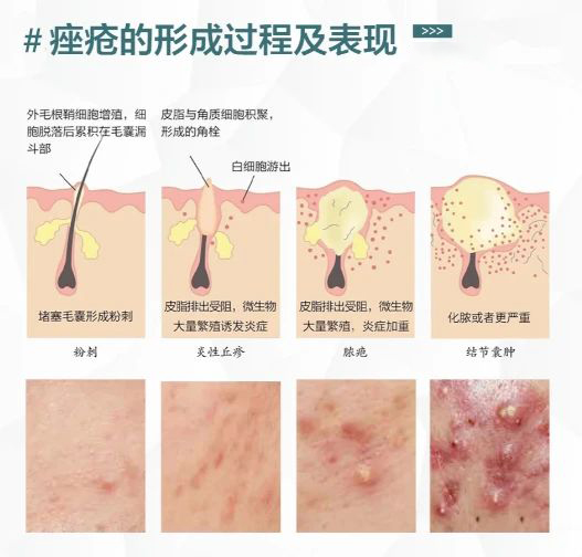 痤疮的形成过程及表现