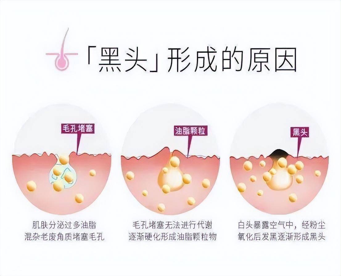 黑头形成的原因